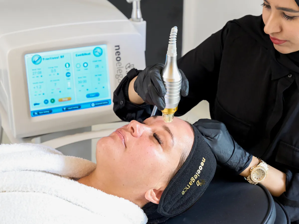 Radiofrequency microneedling treatment at Neo Elegance Skin Clinic, Derby