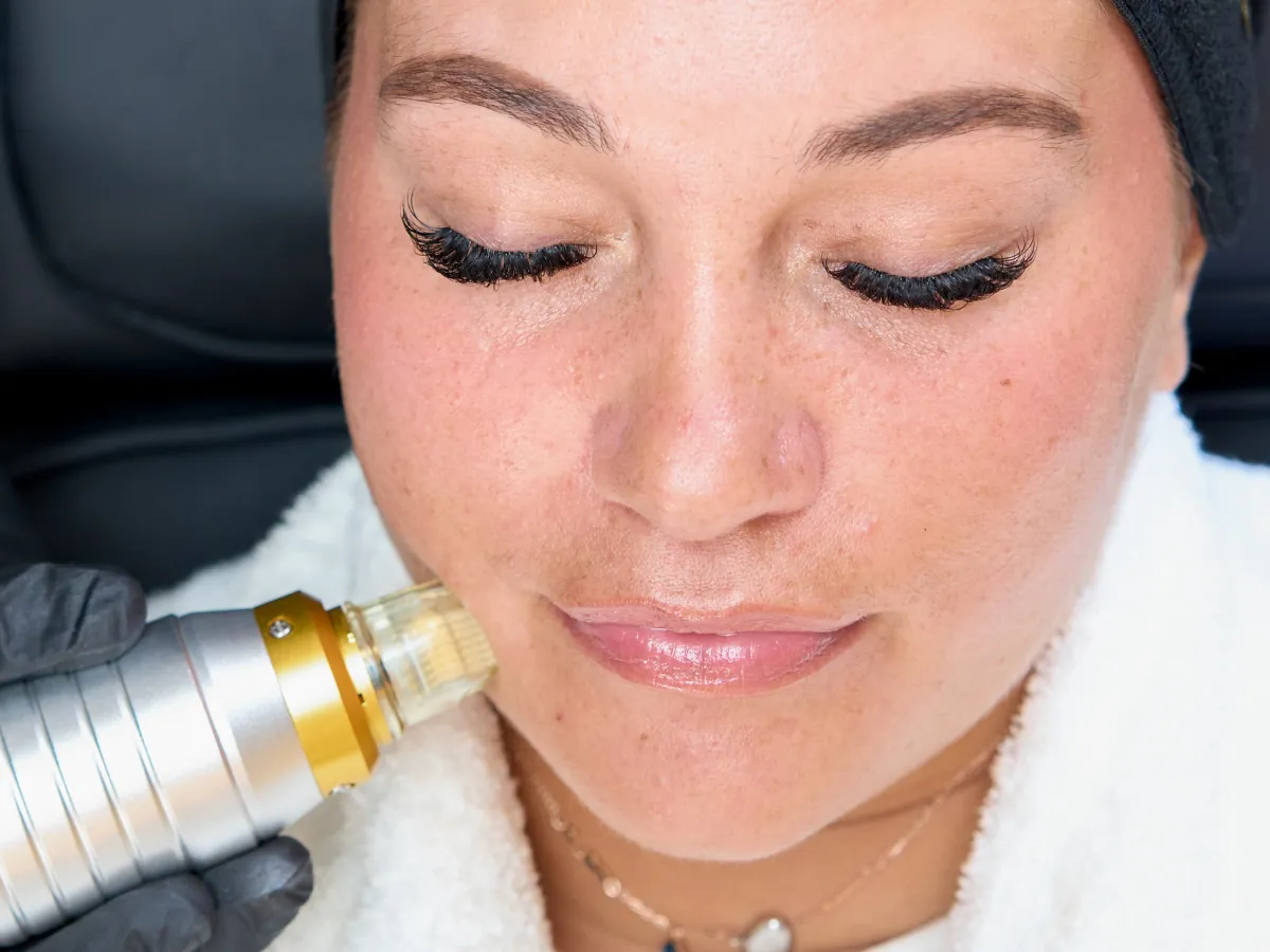 Radiofrequency microneedling along the jawline at our Derby clinic